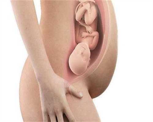 广州代孕好妈妈,女人上了环更容易得子宫肌瘤妇